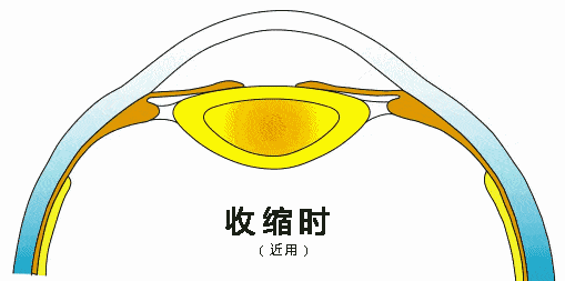 戴眼镜会不会让近视度数加深越来越快？