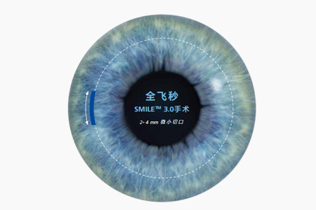 全飞秒近视眼手术后多久能打球 全飞秒近视眼手术后多久能打球