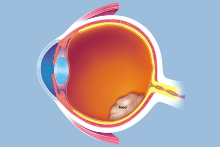 撅眼最快的治疗方法是什么 需要如何防止复发？