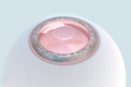 依镜PRL晶体植入术注意事项，尤其第二步！