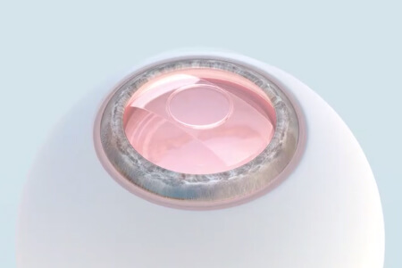 震惊！依镜prl手术副作用有这些