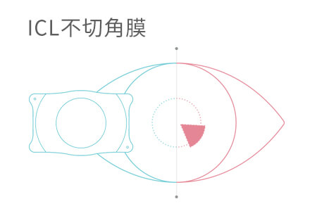 近视200散光200能做icl手术吗？答案在这里
