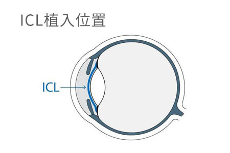 专家揭秘：近视手术多少度能做晶体植入？