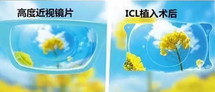 ?哪些近视眼的矫正手术更值得推荐呢？