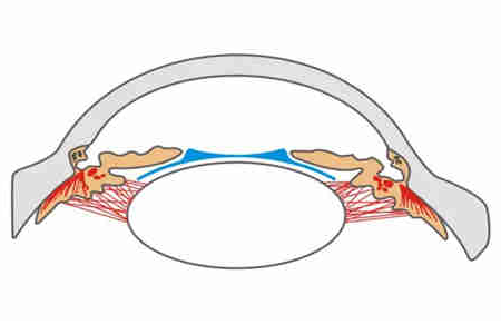 PRL晶体植入术的弊端多不多？