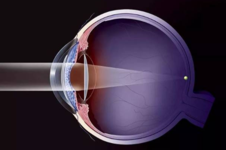 1000以上的近视怎么办？还能做近视手术嘛？