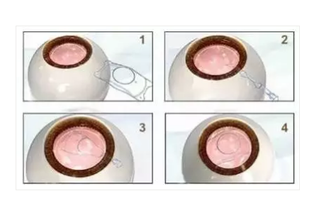 ICL人工晶体植入手术时间长吗？需要哪些准备？