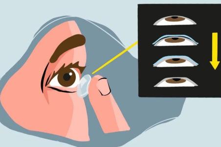 婴儿也会得白内障真的假的？