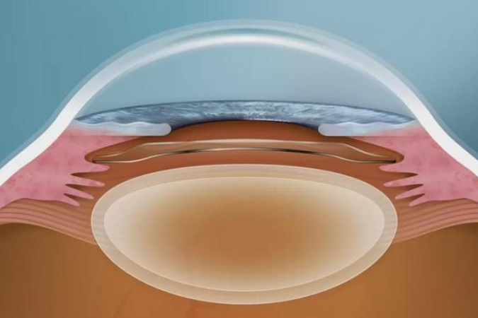 做ICL晶体植入术可以矫正多少度近视呢？