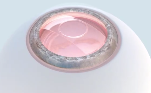 ICL多少钱？在合肥做个ICL一共花多少钱？