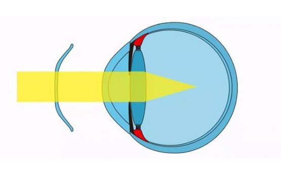 角膜塑形镜干放可以放多久呢？