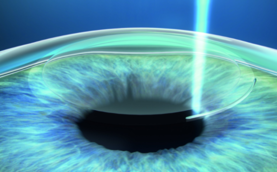 合肥眼科手术是全飞秒好还是半飞秒好？