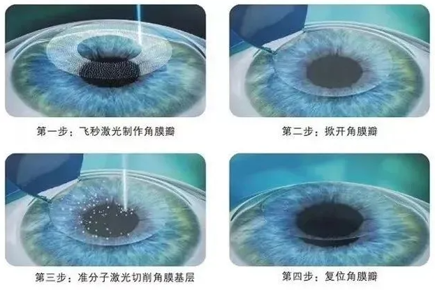 精雕半飞秒和全飞秒还有半飞秒有什么区别？