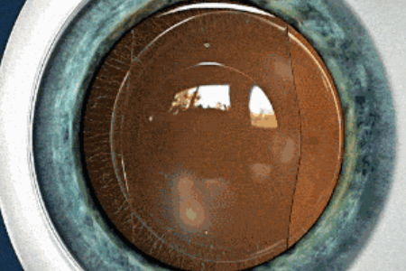 ICL人工晶体植入手术后眼睛会有异物感吗？会不会出现排斥反应？