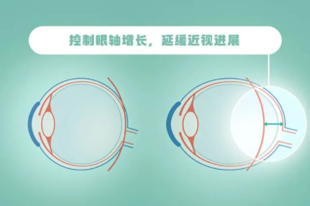 儿童智能近视眼镜能控制视力增长嘛？
